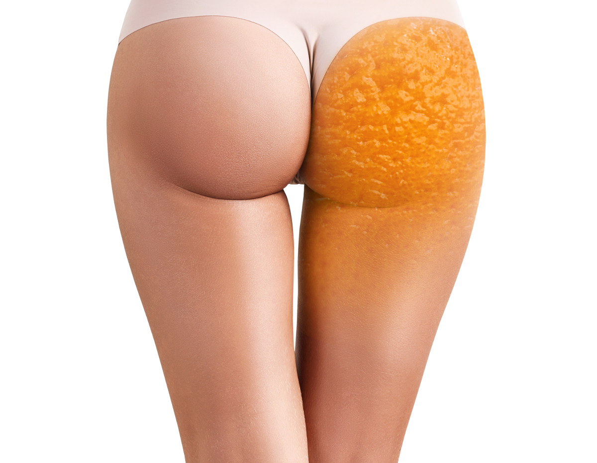 a zsír és a cellulit elégetésének legjobb módja étrend narancsbőr ellen